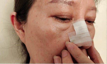 2 Weeks After Rhinoplasty Swelling